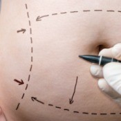 Close up of belly with pen marking plastic surgery lines