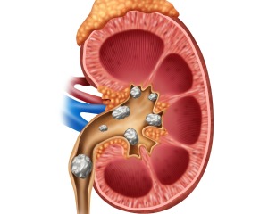 Picture of a kidney containing kidney stones