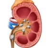 Picture of a kidney containing kidney stones