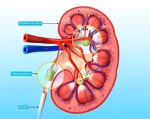 Medical sketch of a kidney with kidney stones