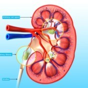Medical sketch of a kidney with kidney stones