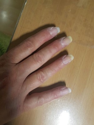Nails Yellowing on Tips