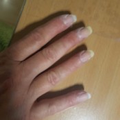 Nails Yellowing on Tips