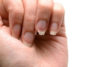 Close up of woman's hand with broken nail