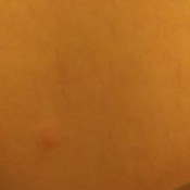 Getting Rid of Small Flying Biting Insects