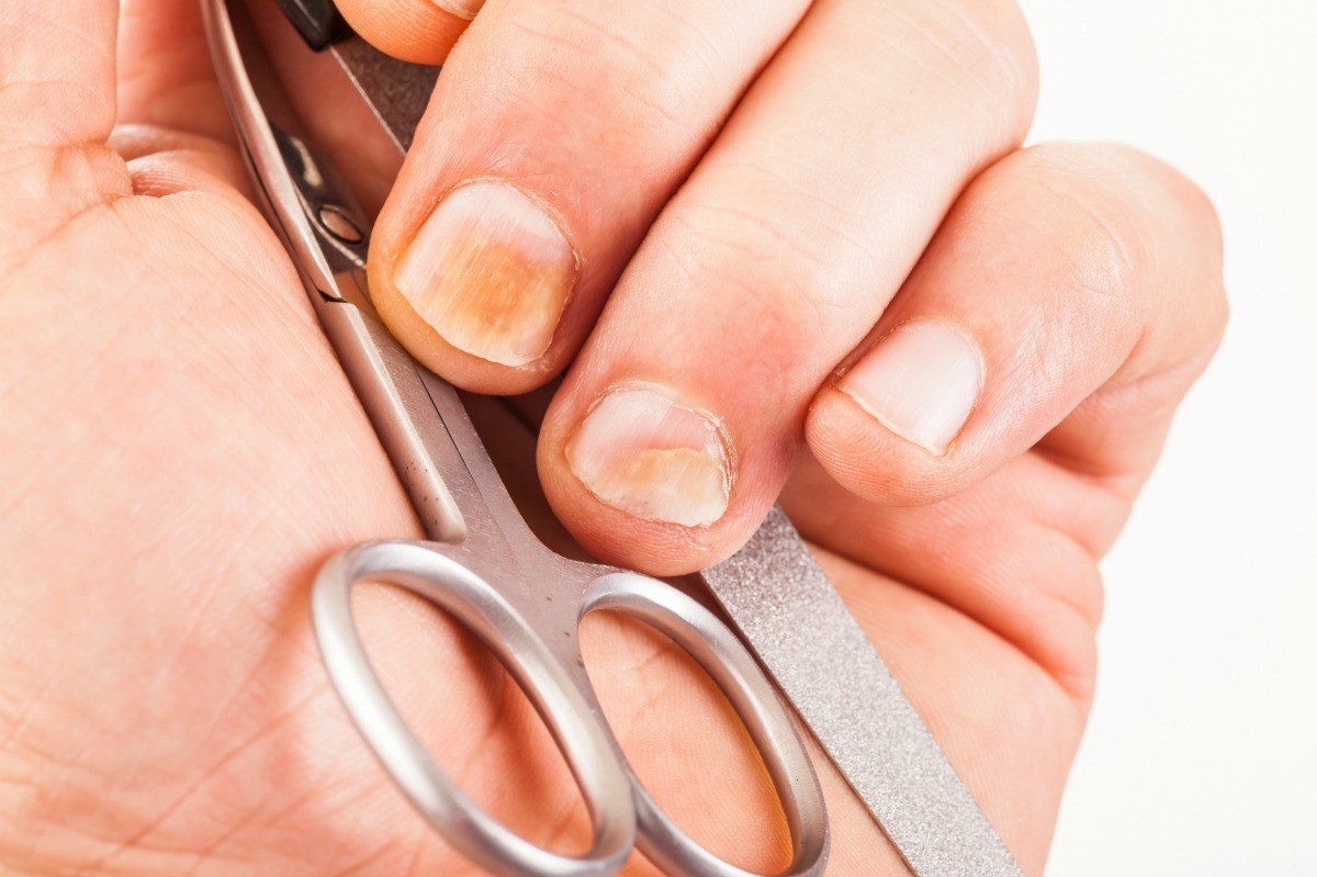 How To Get Rid Of Yellow Fingernails From Nail Polish