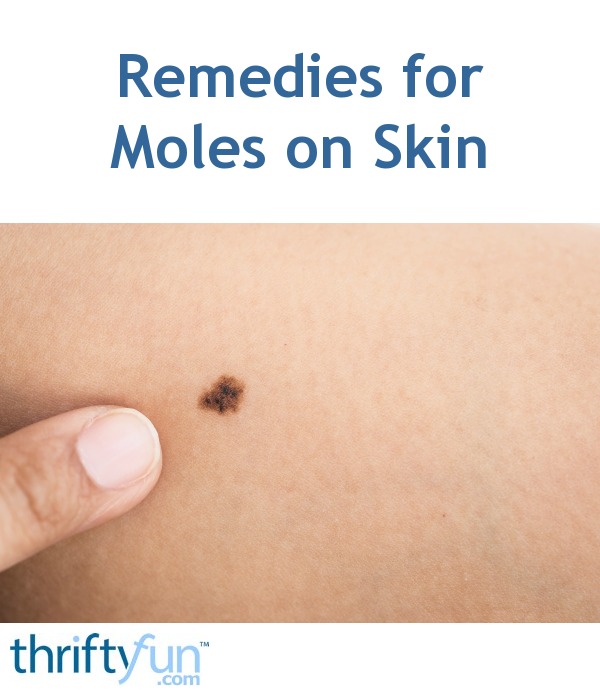 Remedies for Moles on Skin | ThriftyFun