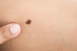 Finger pointing at a mole on skin
