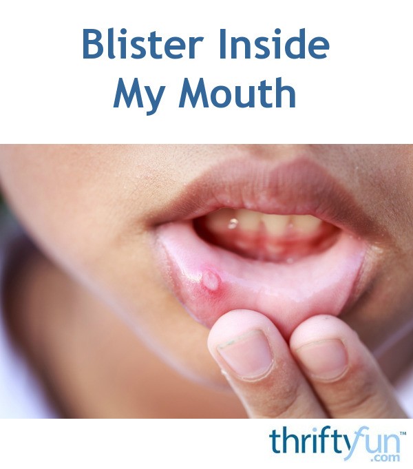 Blister Inside My Mouth - Porn Mms