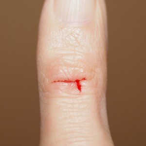 A paper cut on a finger.