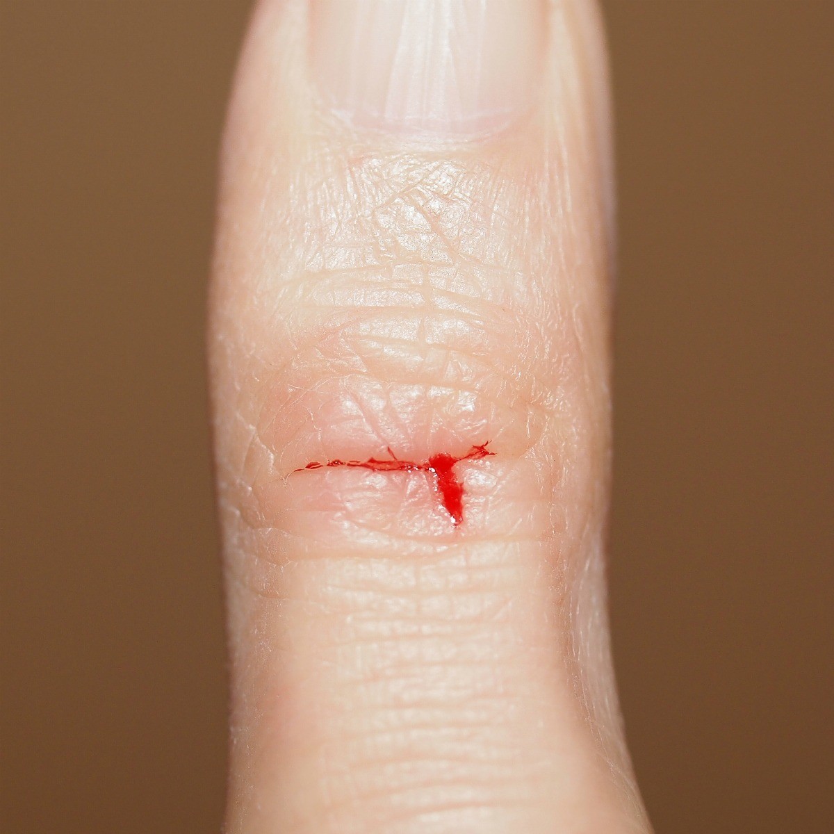 Home Remedies For Paper Cuts ThriftyFun