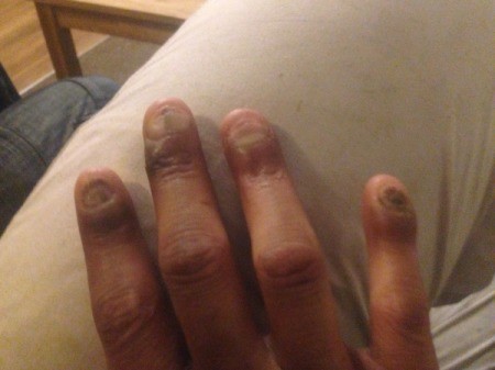 Stopping Nail Biting - badly bitten nails