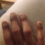 Stopping Nail Biting - badly bitten nails