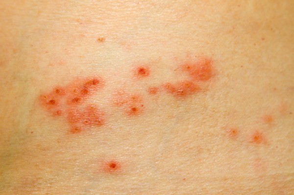 does shingles itch