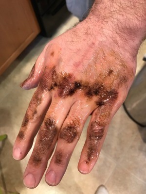 Removing Roof Tar From Skin With Olive Oil - tar on hand