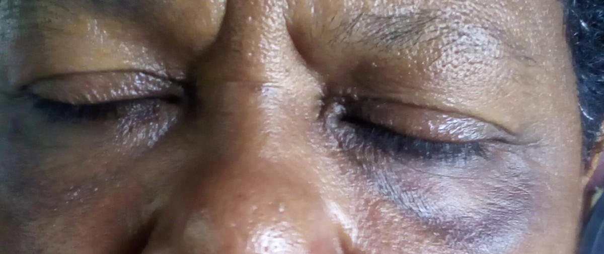 mederma cream for dark circles