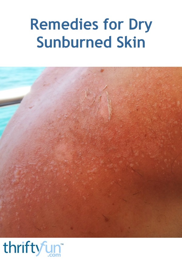 Remedies for Dry Sunburned Skin ThriftyFun