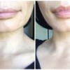 Homemade Plumping Lip Exfoliator - before and after photo