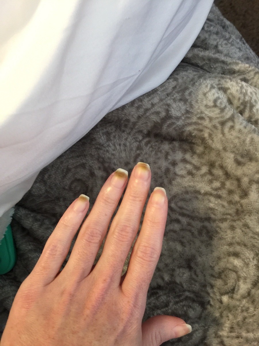 Bruising After Removing Dip Powder Nails? | ThriftyFun