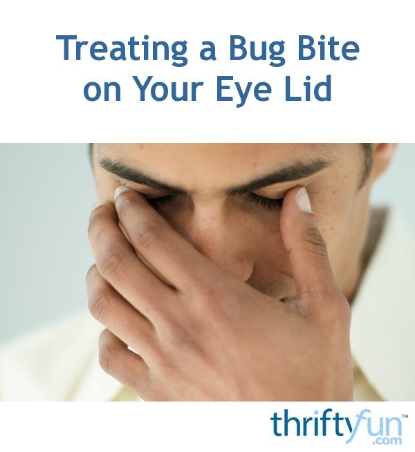 Treating a Bug Bite on Your Eye Lid | ThriftyFun