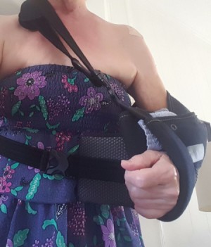 A woman wearing a sleeveless sun dress with her arm in a sling.