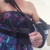A woman wearing a sleeveless sun dress with her arm in a sling.