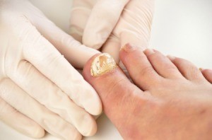 Foot with Nail Fungus