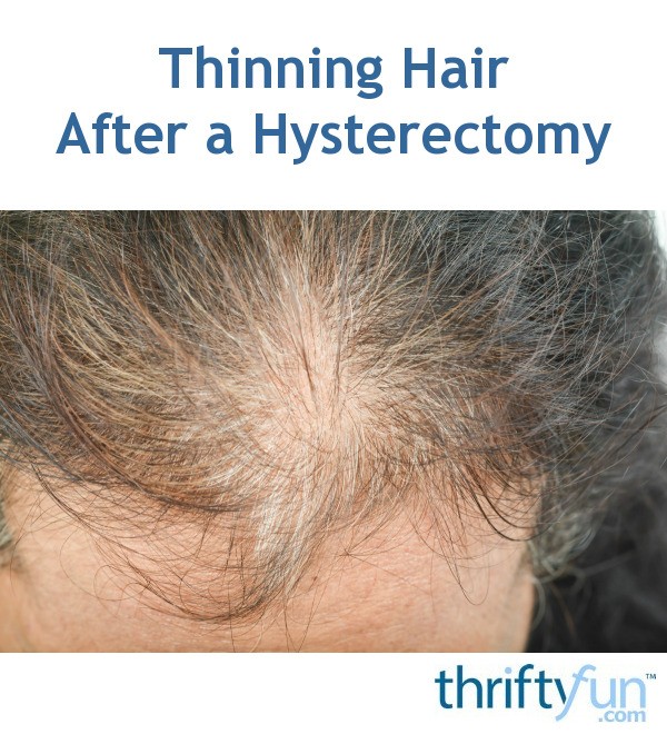 Thinning Hair After a Hysterectomy? ThriftyFun