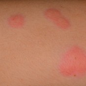 Red bug bites on a person's skin.