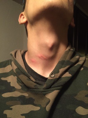 Insect bites on the neck of a person.