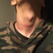 Insect bites on the neck of a person.