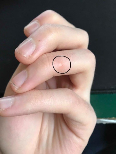 Itchy Bug Bites on My Fingers