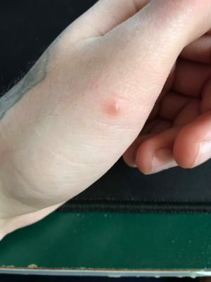 Itchy Bug Bites on My Fingers - small bug bite like blister