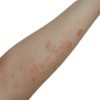 Scabies Bites on an arm
