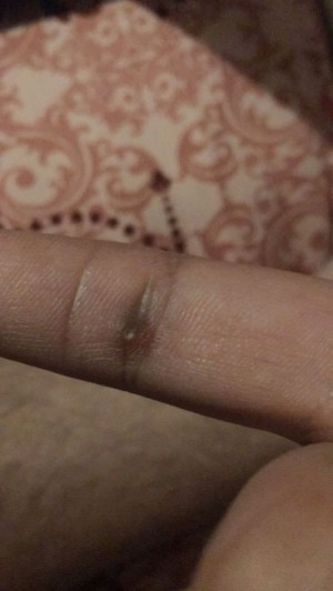 Identifying a Pimple-like Sore on Finger
