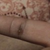 Identifying a Pimple-like Sore on Finger