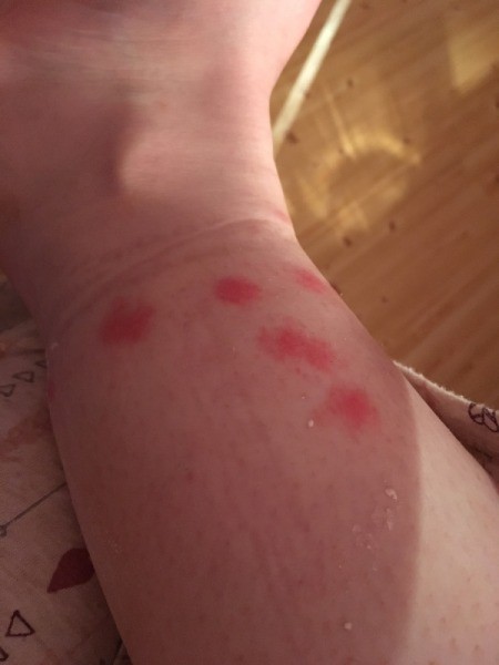 Identifying a Small Black Biting Bug - red bite marks on arm