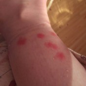 Identifying a Small Black Biting Bug - red bite marks on arm