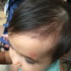 Top of baby's scalp