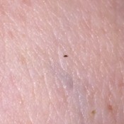Getting Rid of Small Black Biting Bugs  - bug on skin