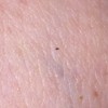 Getting Rid of Small Black Biting Bugs  - bug on skin