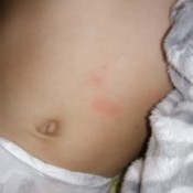 Getting Rid of Fleas on Bedding - flea bites on child's tummy