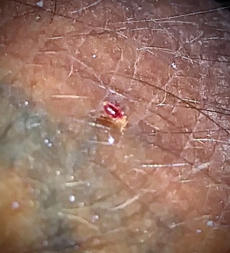 Identifying Biting Bugs