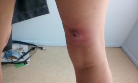 Treating Boils - boil on back of leg above the knee