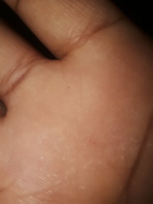Removing a Piece of Glass Embedded in Skin - tiny spot on palm