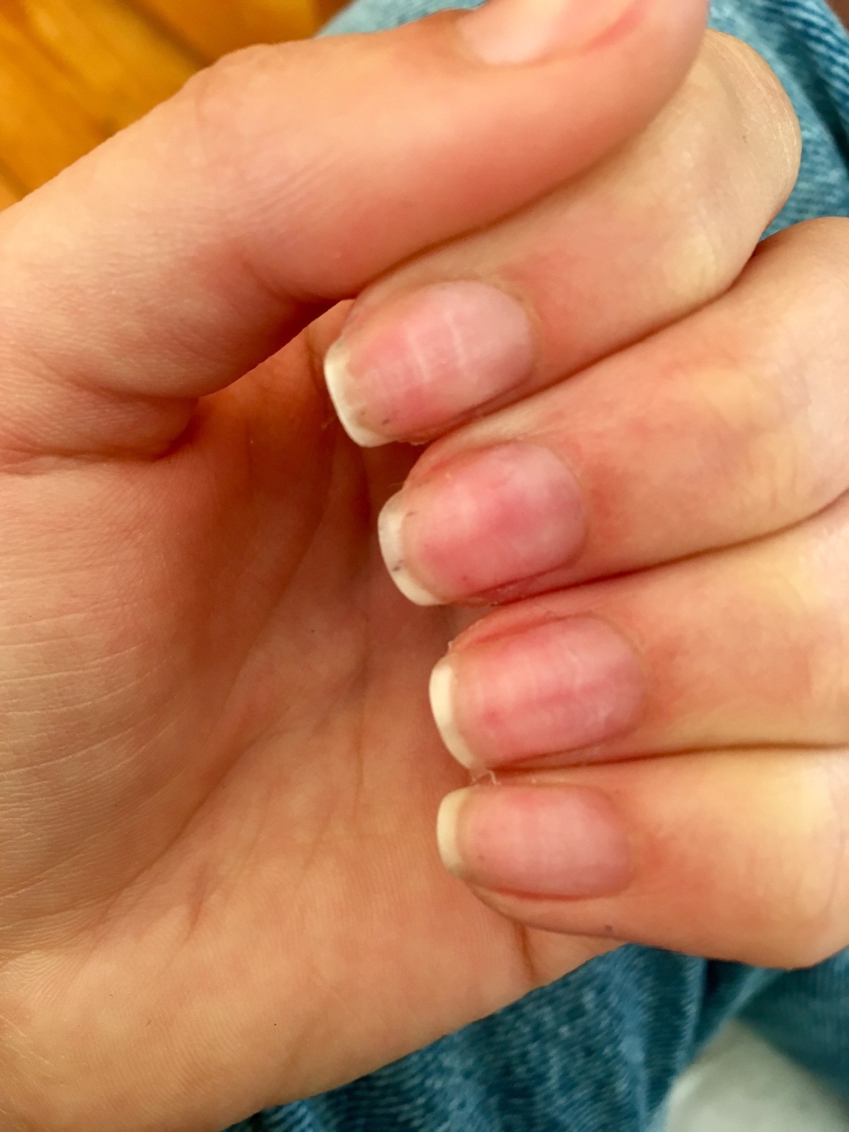 Remedies For Nail Pain After Removing Acrylic Nails Thriftyfun
