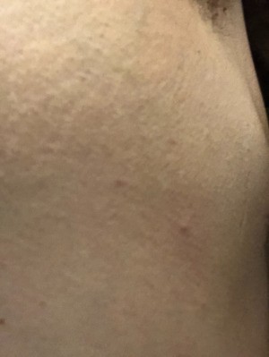 Cause of Tiny Red Itchy Spots - closeup of spot in skin