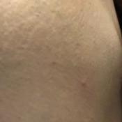 Cause of Tiny Red Itchy Spots - closeup of spot in skin