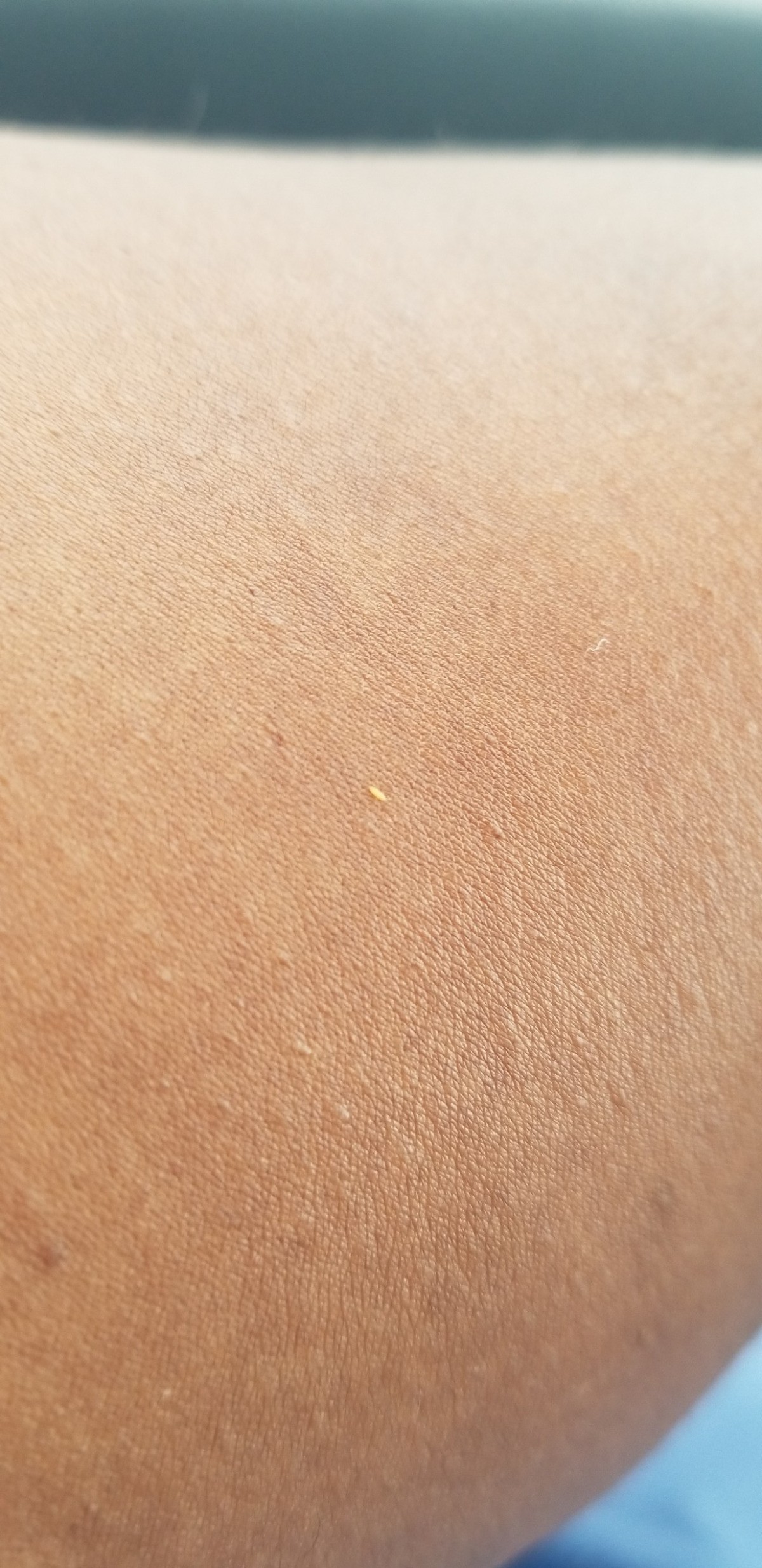 What Are These Tiny Bugs Biting Me