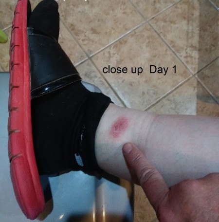 Identifying a Bug Bite